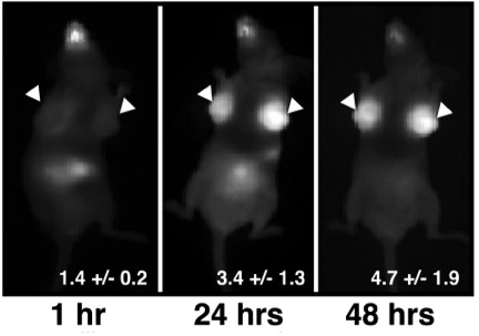 Breast cancer tumors light up with infrared light